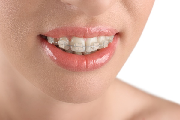 Can Adults Have Orthodontic Treatments?