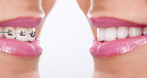 How to Choose the Right Orthodontist in Stockton